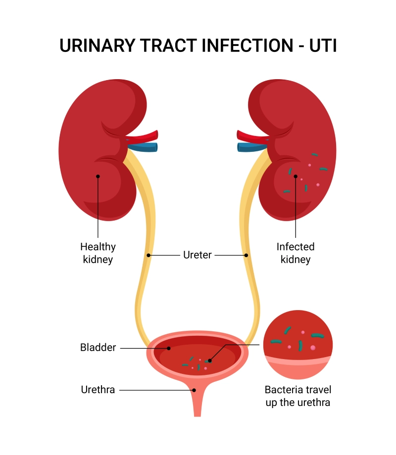 Urinary tract infection diagram explained by Best Gynecologist in Kharadi Pune Dr. Mansi Sharma at Ojas Clinic